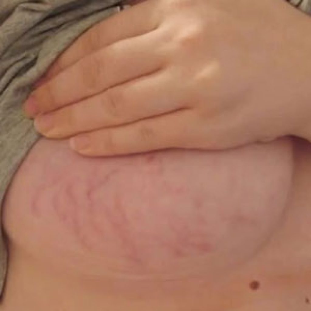 растяжки на груди во время беременности фото фото 74