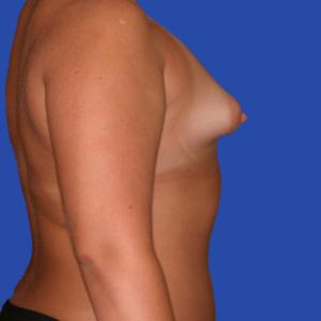 тубулярная форма груди у женщин фото 85